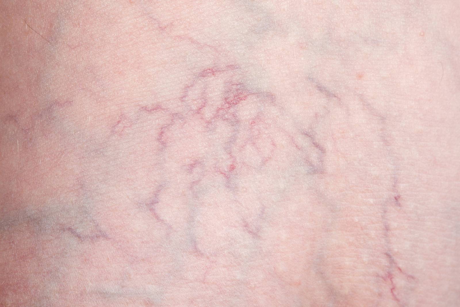 The Spider Veins on Your Face Are Treatable ARIA Vein Center